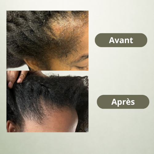 Roll-On Activateur Cuir Chevelu - AMÉA™